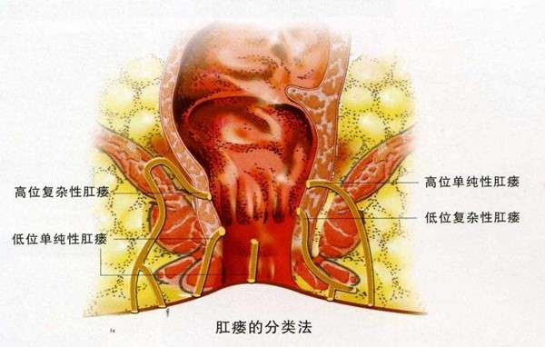 什么是肛瘘图片