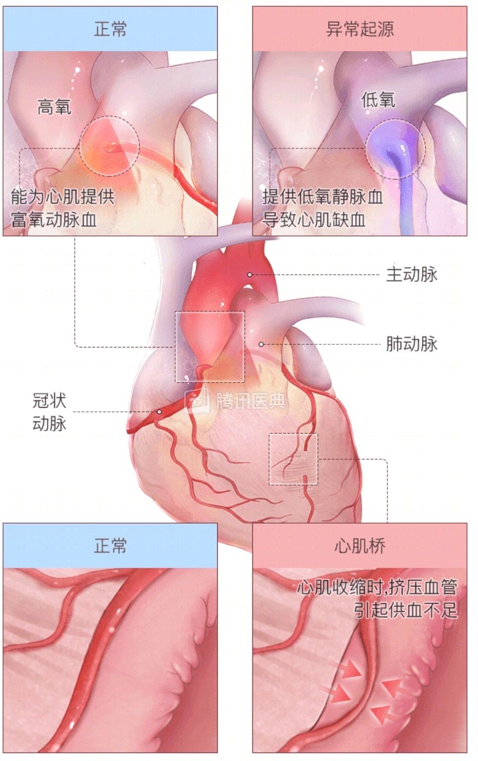 心绞痛是怎么回事？