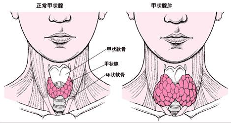 三度单纯性甲状腺肿大